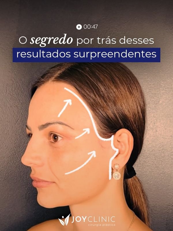 Facelift