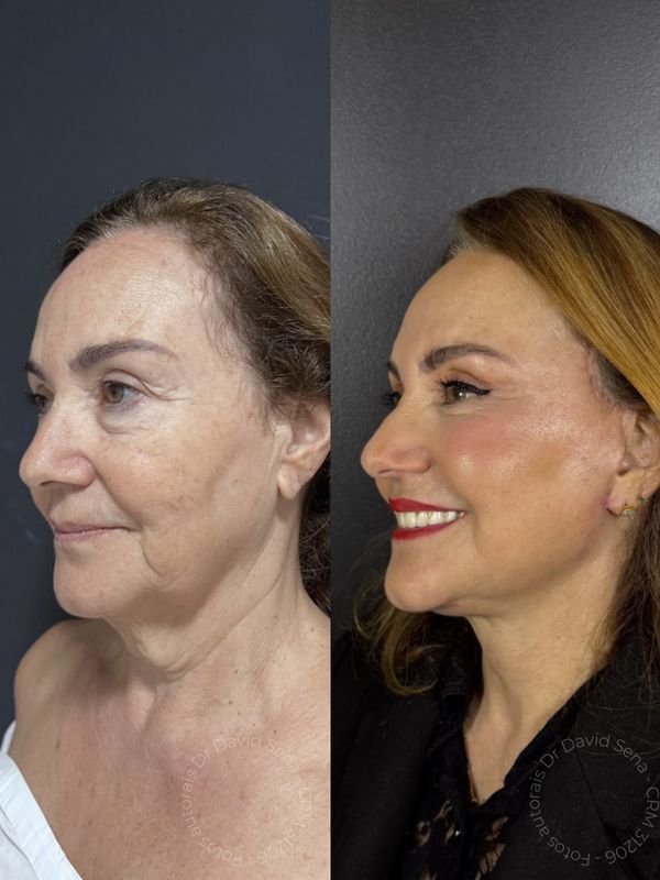 Antes e depois