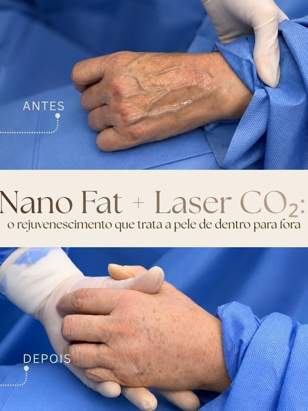 Nano fat e laser de CO2